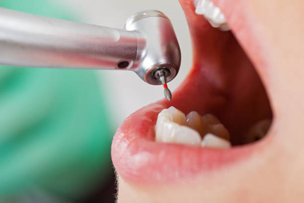 Best Emergency Dental Care for Abscessed Tooth in Rock Creek, AL
